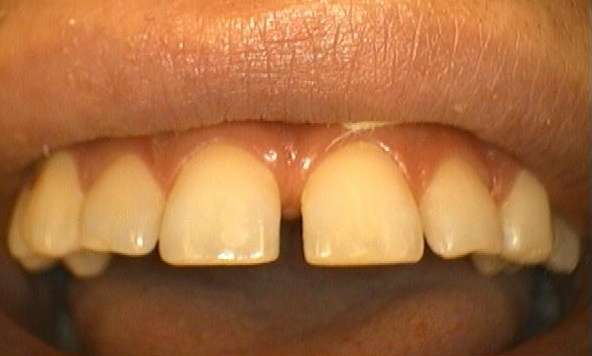 before no prep porcelain veneers, Garran ACT