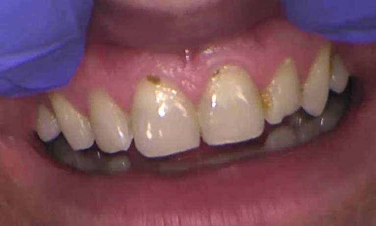Professional-Teeth-Cleaning-Before-Image