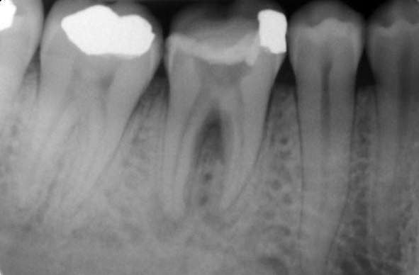 tooth abscess before root canal therapy, Canberra ACT