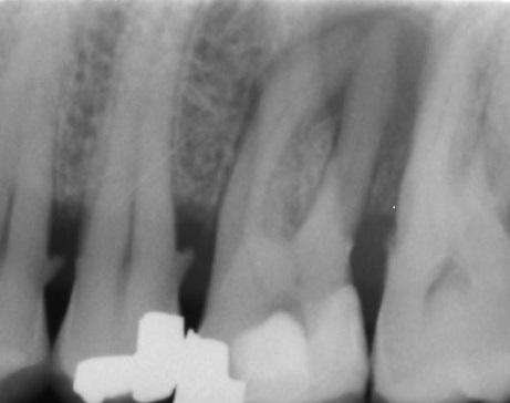 tooth abscess before root canal therapy, Canberra ACT