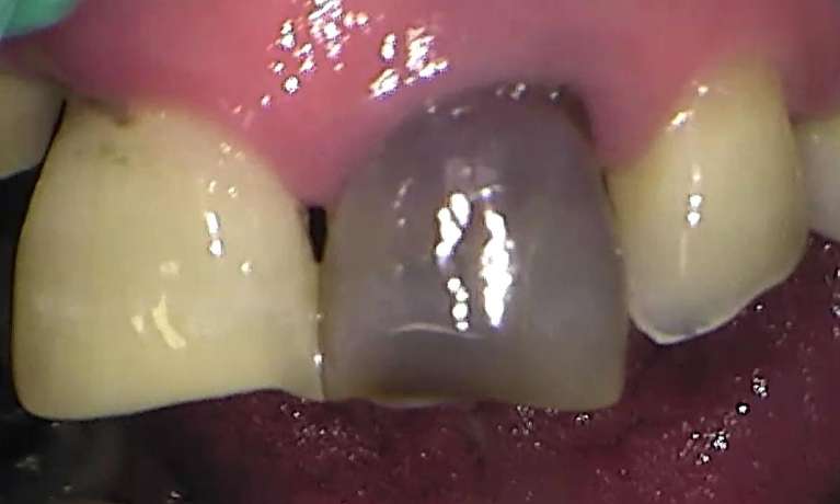 before root canal therapy and teeth whitening, Garran ACT