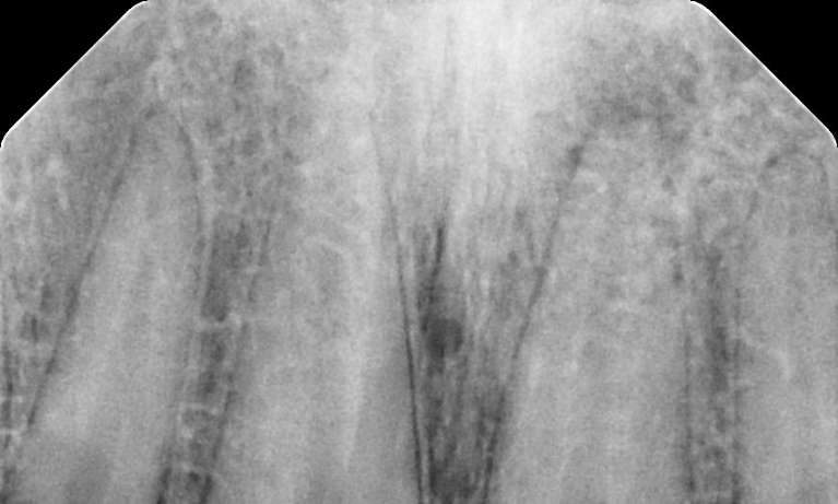 before root canal therapy, Garran ACT