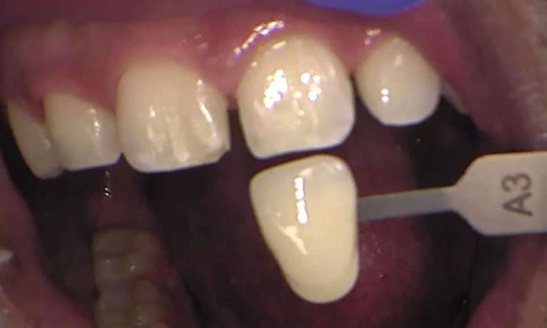 Before zoom teeth whitening services, Garran ACT