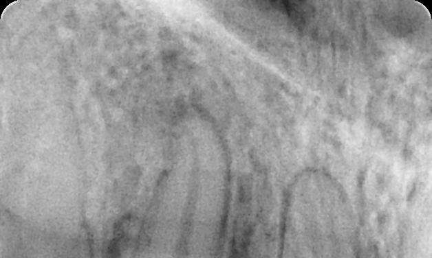 before root canal therapy, Garran ACT