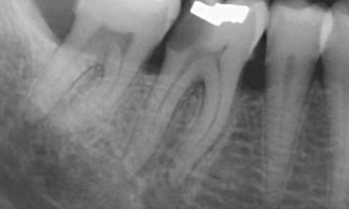 before emergency tooth extraction, Canberra ACT