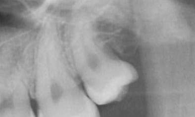 Before wisdom tooth extraction, Garran ACT