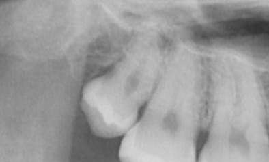 Before wisdom tooth extraction, Canberra ACT