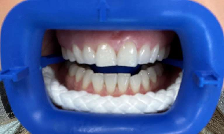 Zoom-In-chair-Teeth-Whitening-Before-Image