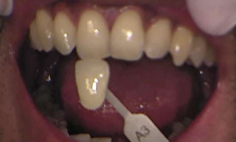 Before zoom teeth whitening services, Canberra ACT