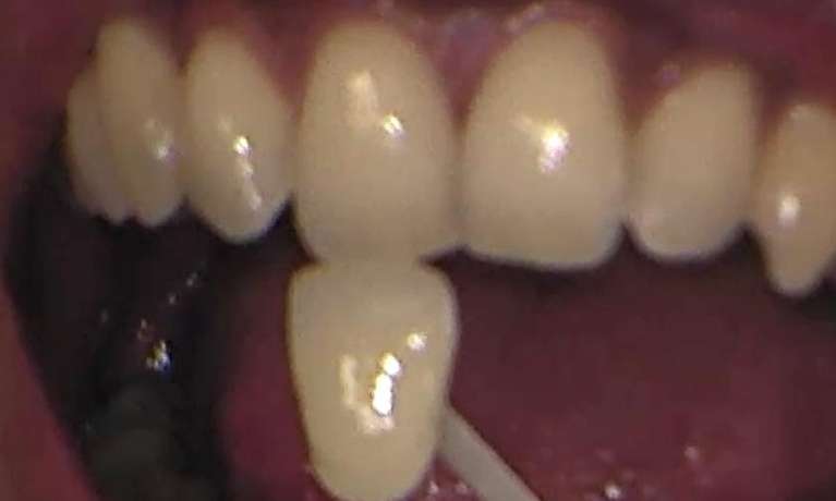 before zoom teeth whitening services, Garran ACT