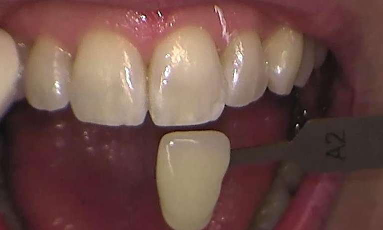 Before zoom teeth whitening services, Garran ACT