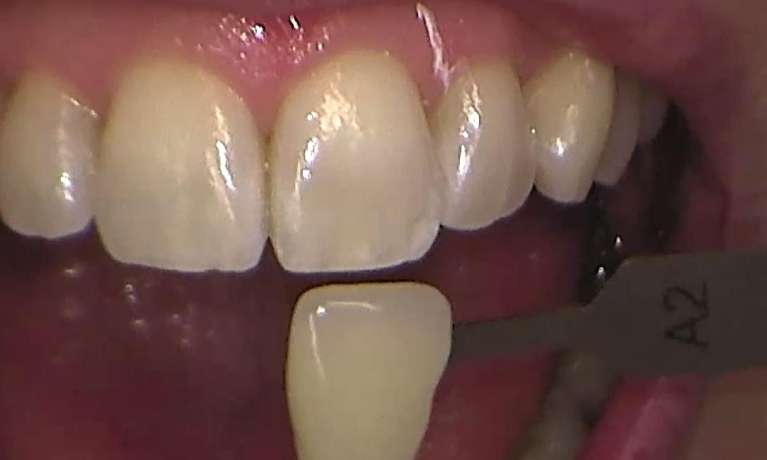 Before zoom teeth whitening services, Canberra ACT