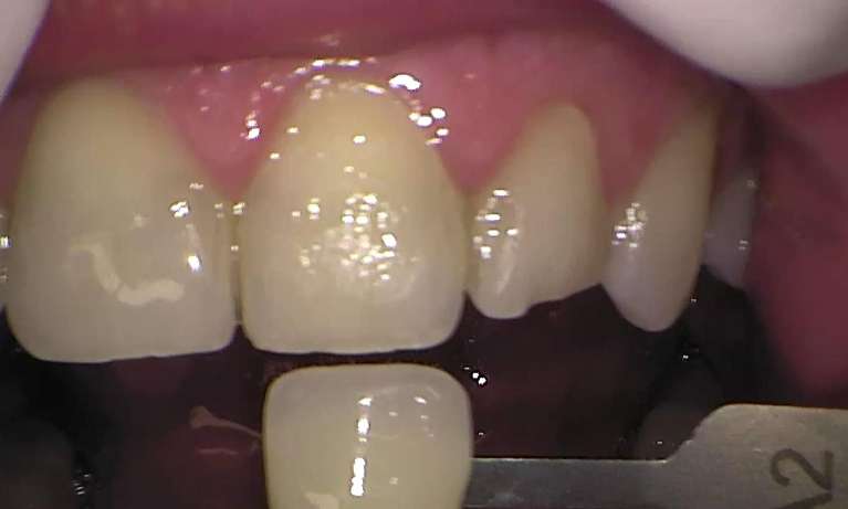 Before zoom teeth whitening, Garran ACT