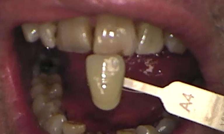 Before zoom teeth whitening services, Canberra ACT