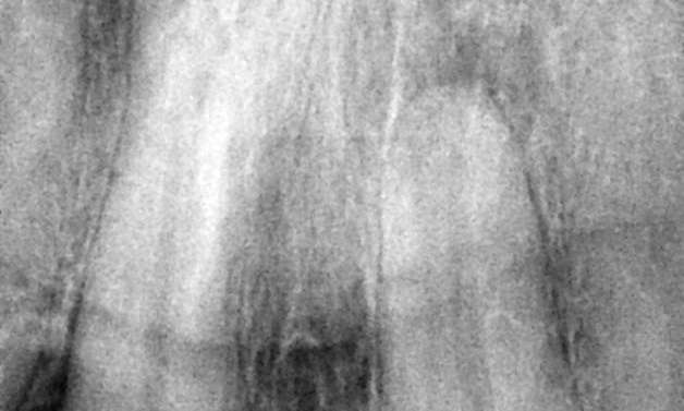 before root canal therapy x-ray, Garran ACT